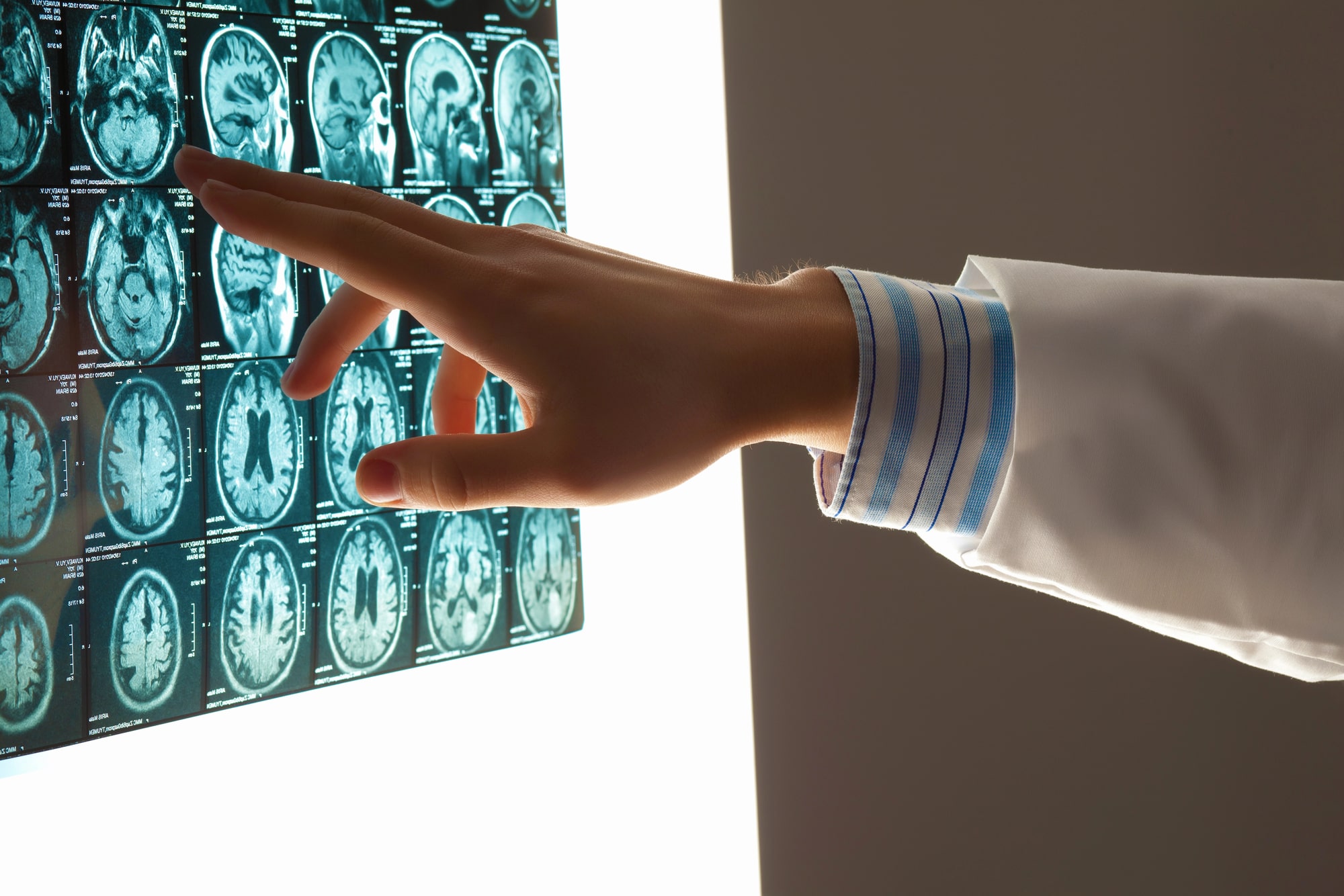Cleveland brain injury lawyer explains symptoms
